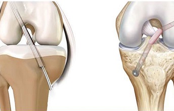 Best Arthroscopic ACL Meniscus Surgeon in Kurla, Mumbai